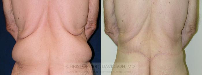 Lower Body Lift Case 177 Before & After View #3 | Boston, MA | Christopher J. Davidson, MD