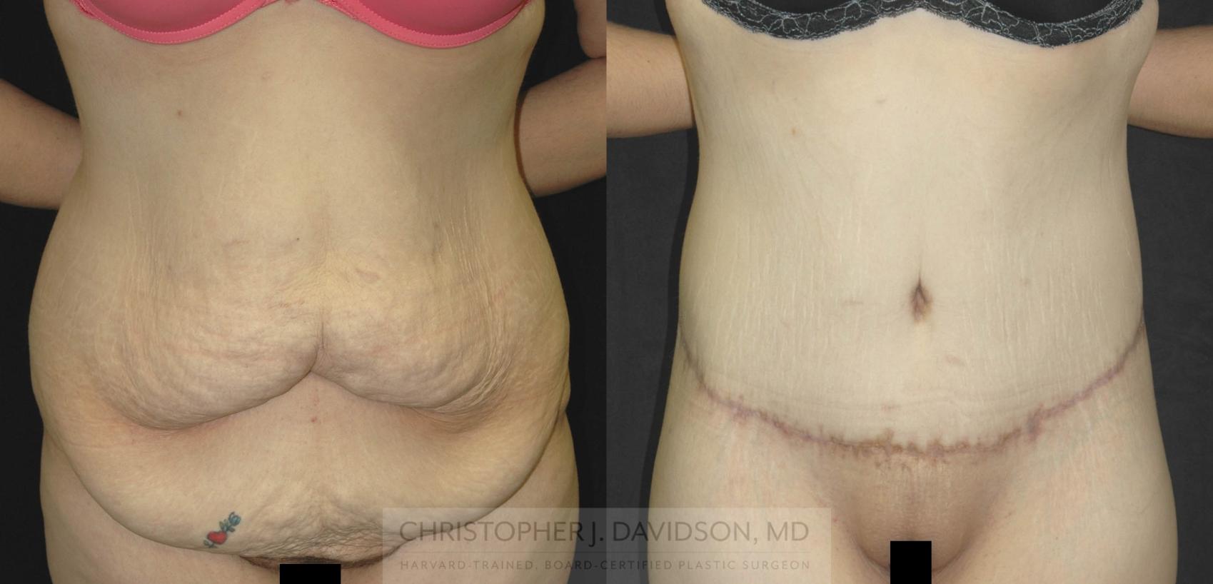 Lower Body Lift Case 181 Before & After View #1 | Wellesley, MA | Christopher J. Davidson, MD