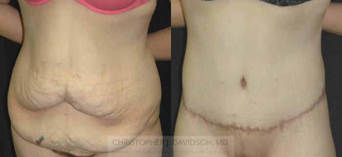 Lower Body Lift Case 181 Before & After View #2 | Boston, MA | Christopher J. Davidson, MD