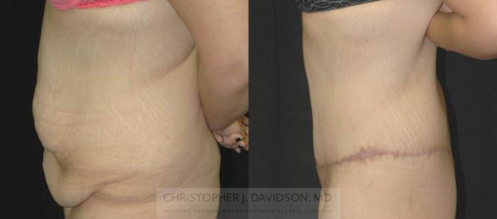 Lower Body Lift Case 181 Before & After View #3 | Boston, MA | Christopher J. Davidson, MD