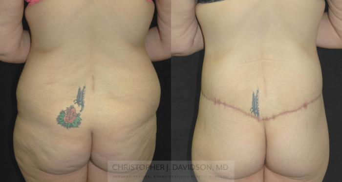 Lower Body Lift Case 181 Before & After View #4 | Boston, MA | Christopher J. Davidson, MD