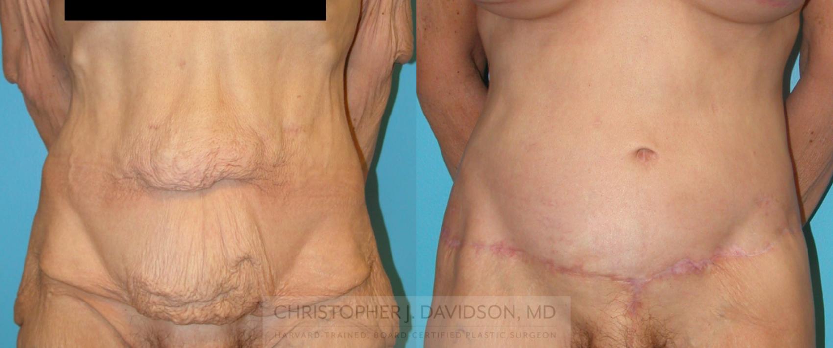 Lower Body Lift Case 193 Before & After View #1 | Boston, MA | Christopher J. Davidson, MD