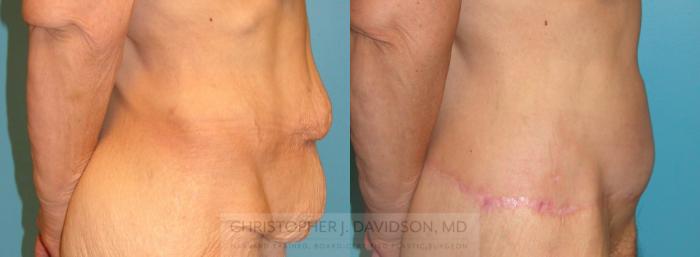 Lower Body Lift Case 193 Before & After View #2 | Boston, MA | Christopher J. Davidson, MD