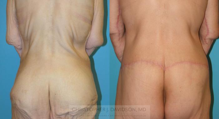 Lower Body Lift Case 193 Before & After View #3 | Boston, MA | Christopher J. Davidson, MD