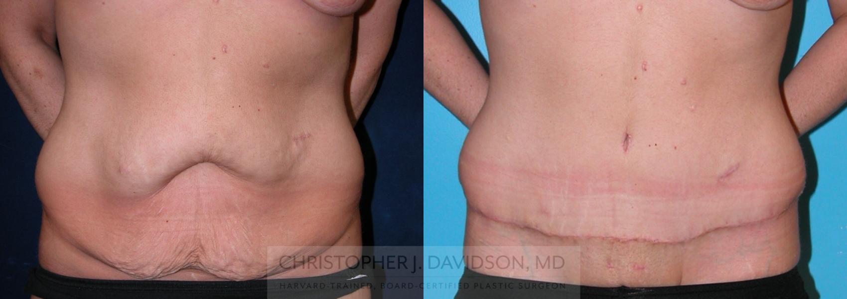 Lower Body Lift Case 202 Before & After View #1 | Wellesley, MA | Christopher J. Davidson, MD