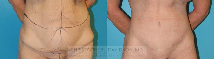 Lower Body Lift Case 204 Before & After View #1 | Boston, MA | Christopher J. Davidson, MD