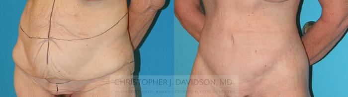 Lower Body Lift Case 204 Before & After View #2 | Boston, MA | Christopher J. Davidson, MD