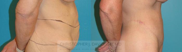 Lower Body Lift Case 204 Before & After View #3 | Boston, MA | Christopher J. Davidson, MD