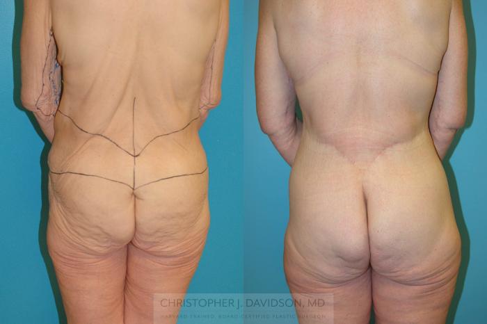 Lower Body Lift Case 204 Before & After View #4 | Boston, MA | Christopher J. Davidson, MD
