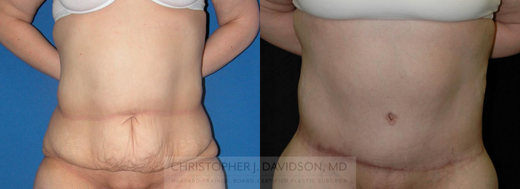 Lower Body Lift Case 207 Before & After View #1 | Boston, MA | Christopher J. Davidson, MD