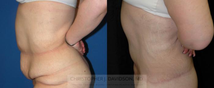 Lower Body Lift Case 207 Before & After View #2 | Boston, MA | Christopher J. Davidson, MD