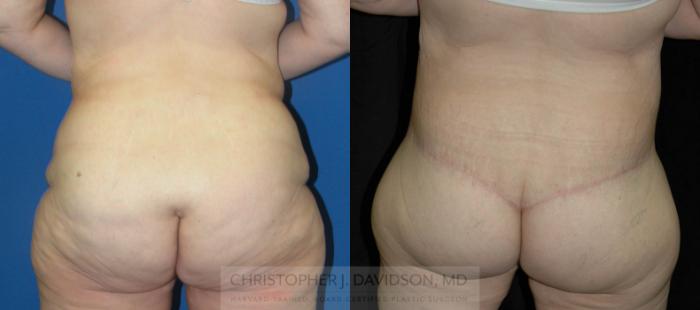 Lower Body Lift Case 207 Before & After View #3 | Boston, MA | Christopher J. Davidson, MD