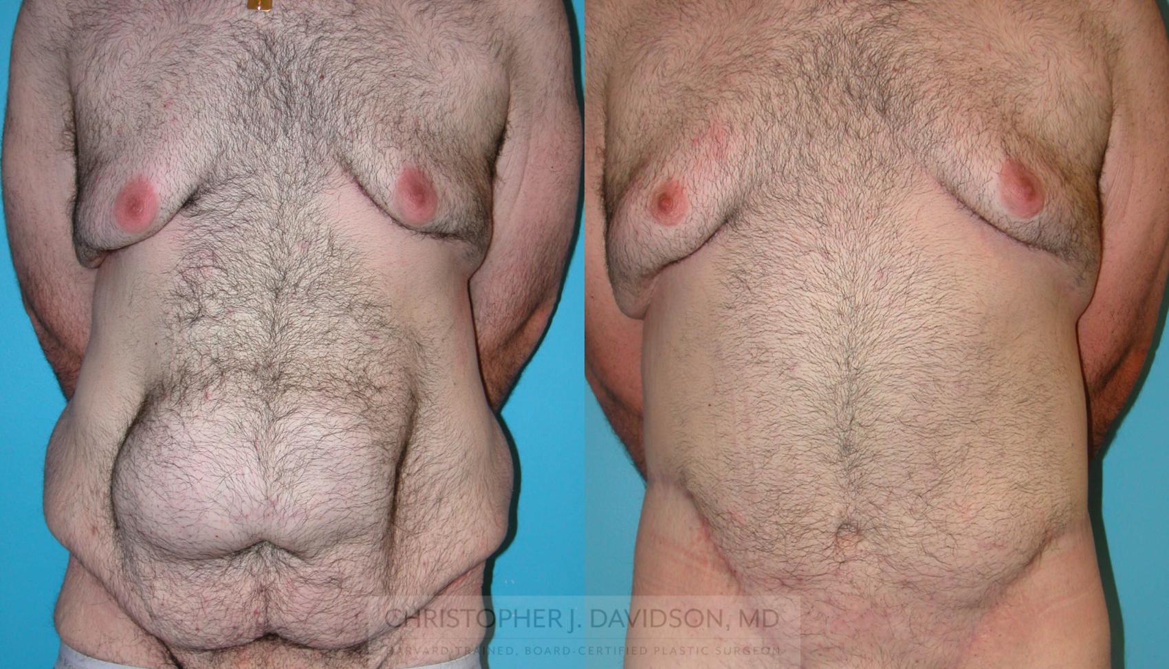 Lower Body Lift Case 212 Before & After View #1 | Wellesley, MA | Christopher J. Davidson, MD