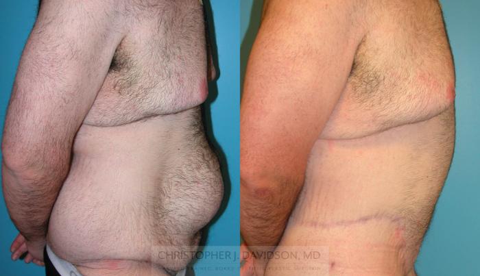 Lower Body Lift Case 212 Before & After View #2 | Boston, MA | Christopher J. Davidson, MD