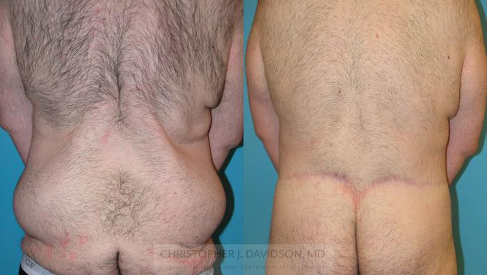 Lower Body Lift Case 212 Before & After View #3 | Boston, MA | Christopher J. Davidson, MD
