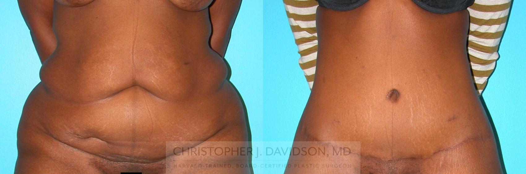 Lower Body Lift Case 216 Before & After View #1 | Boston, MA | Christopher J. Davidson, MD