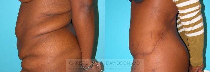 Lower Body Lift Case 216 Before & After View #2 | Boston, MA | Christopher J. Davidson, MD