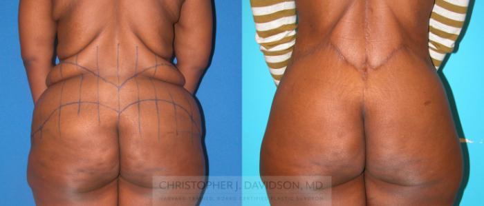 Lower Body Lift Case 216 Before & After View #3 | Boston, MA | Christopher J. Davidson, MD