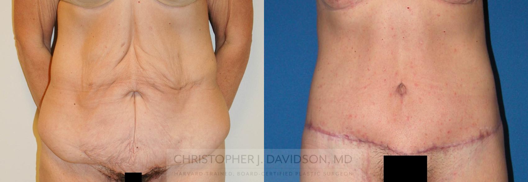 Lower Body Lift Case 225 Before & After View #1 | Wellesley, MA | Christopher J. Davidson, MD