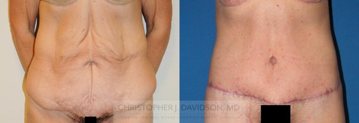 Lower Body Lift Case 225 Before & After View #1 | Boston, MA | Christopher J. Davidson, MD