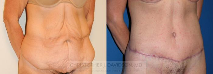 Lower Body Lift Case 225 Before & After View #2 | Boston, MA | Christopher J. Davidson, MD
