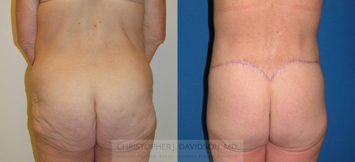 Lower Body Lift Case 225 Before & After View #3 | Boston, MA | Christopher J. Davidson, MD