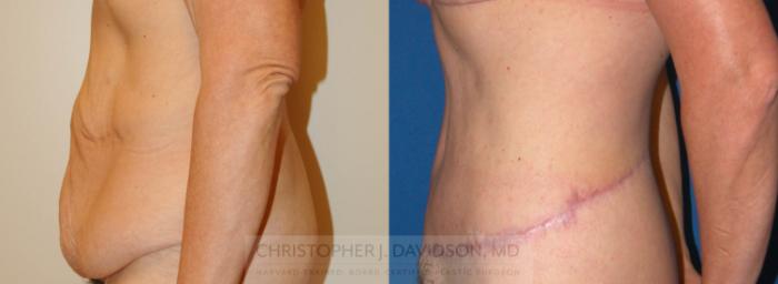 Lower Body Lift Case 225 Before & After View #4 | Boston, MA | Christopher J. Davidson, MD