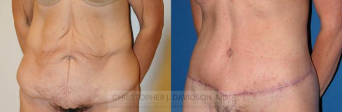 Lower Body Lift Case 225 Before & After View #5 | Boston, MA | Christopher J. Davidson, MD