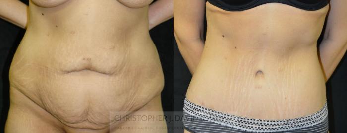 Lower Body Lift Case 24 Before & After View #1 | Boston, MA | Christopher J. Davidson, MD