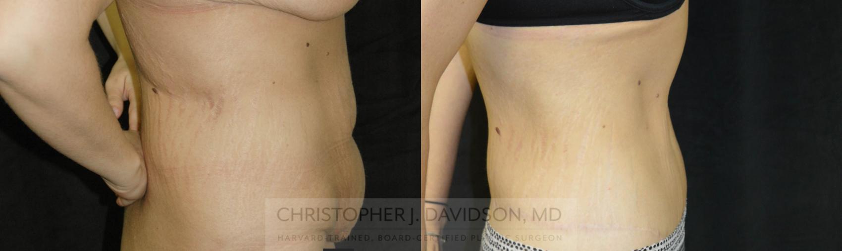 Lower Body Lift Case 24 Before & After View #2 | Wellesley, MA | Christopher J. Davidson, MD