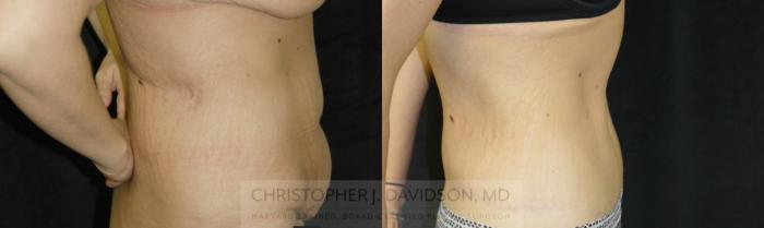 Lower Body Lift Case 24 Before & After View #2 | Boston, MA | Christopher J. Davidson, MD