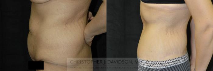 Lower Body Lift Case 24 Before & After View #3 | Boston, MA | Christopher J. Davidson, MD