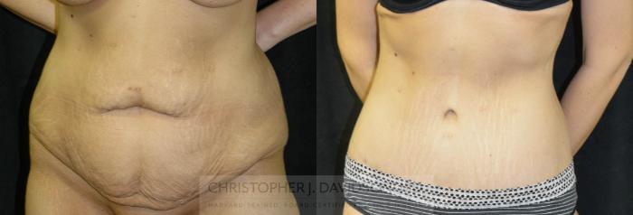 Lower Body Lift Case 24 Before & After View #4 | Boston, MA | Christopher J. Davidson, MD