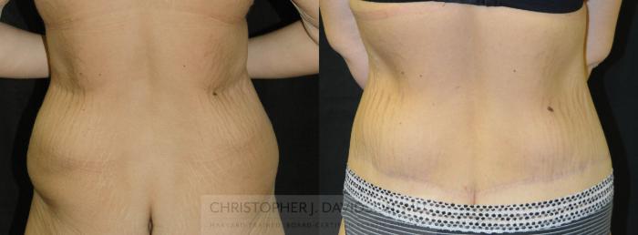 Lower Body Lift Case 24 Before & After View #5 | Boston, MA | Christopher J. Davidson, MD
