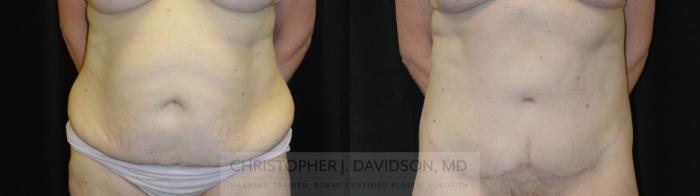 Lower Body Lift Case 435 Before & After Front | Boston, MA | Christopher J. Davidson, MD