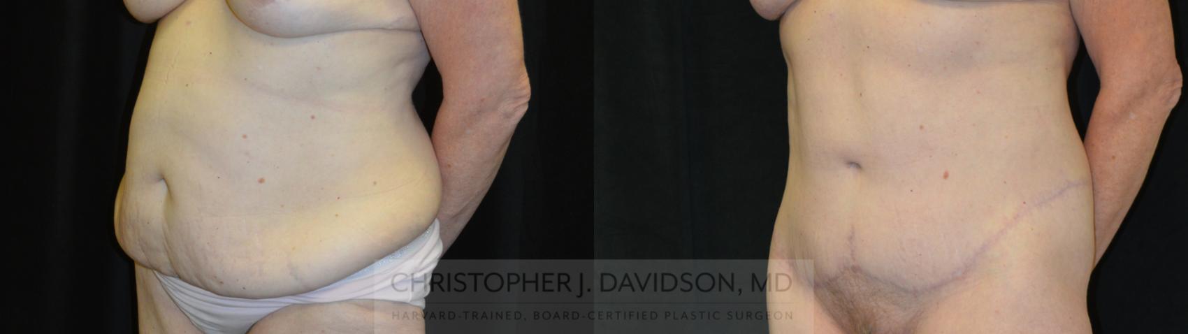 Lower Body Lift Case 435 Before & After Left Oblique | Boston, MA | Christopher J. Davidson, MD