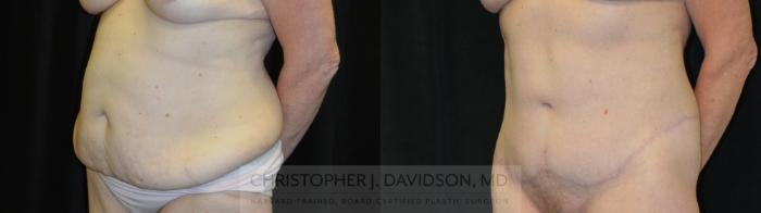 Thigh Lift Case 435 Before & After Left Oblique | Boston, MA | Christopher J. Davidson, MD