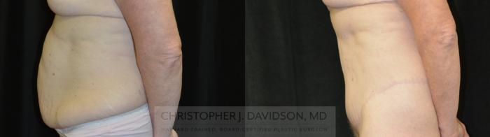 Lower Body Lift Case 435 Before & After Left Side | Boston, MA | Christopher J. Davidson, MD