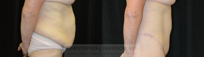 Lower Body Lift Case 435 Before & After Right Side | Boston, MA | Christopher J. Davidson, MD