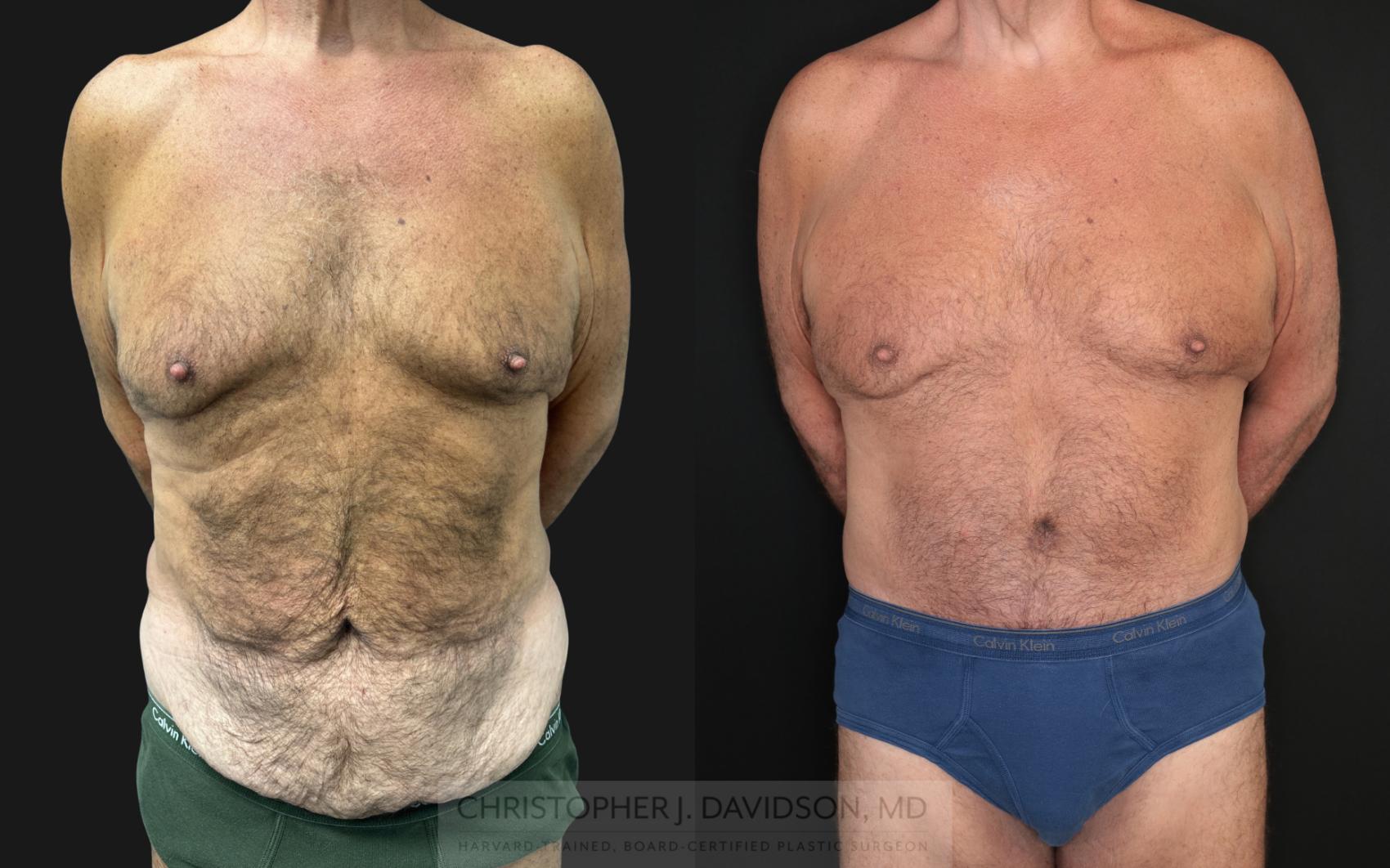 Lower Body Lift Case 483 Before & After Front | Boston, MA | Christopher J. Davidson, MD