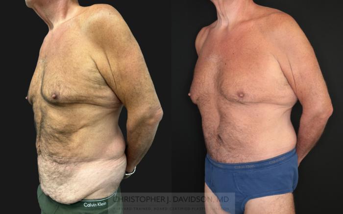 Lower Body Lift Case 483 Before & After Left Oblique | Boston, MA | Christopher J. Davidson, MD