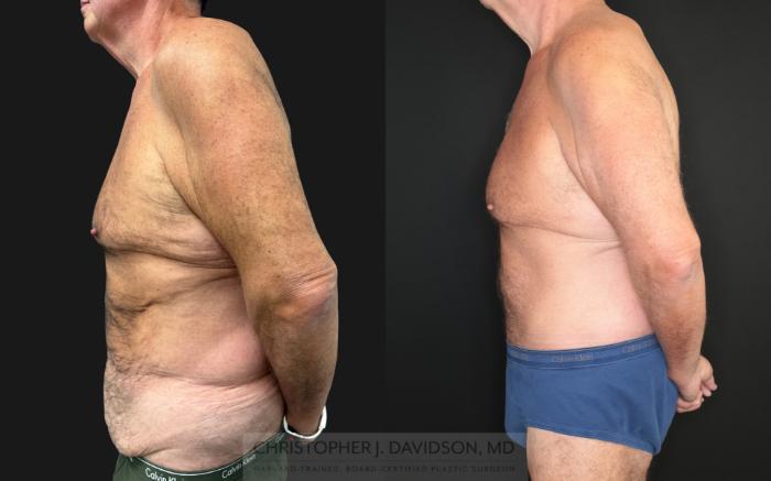 Lower Body Lift Case 483 Before & After Left Side | Boston, MA | Christopher J. Davidson, MD