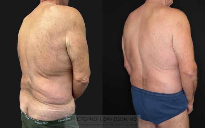 Lower Body Lift Case 483 Before & After Right Oblique | Boston, MA | Christopher J. Davidson, MD