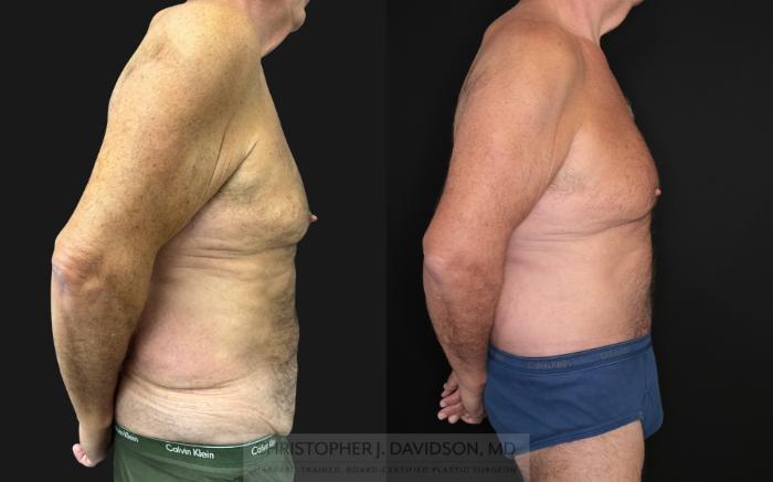 Lower Body Lift Case 483 Before & After Right Side | Boston, MA | Christopher J. Davidson, MD