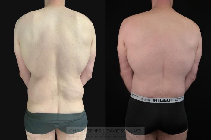 Lower Body Lift Case 486 Before & After Back | Boston, MA | Christopher J. Davidson, MD