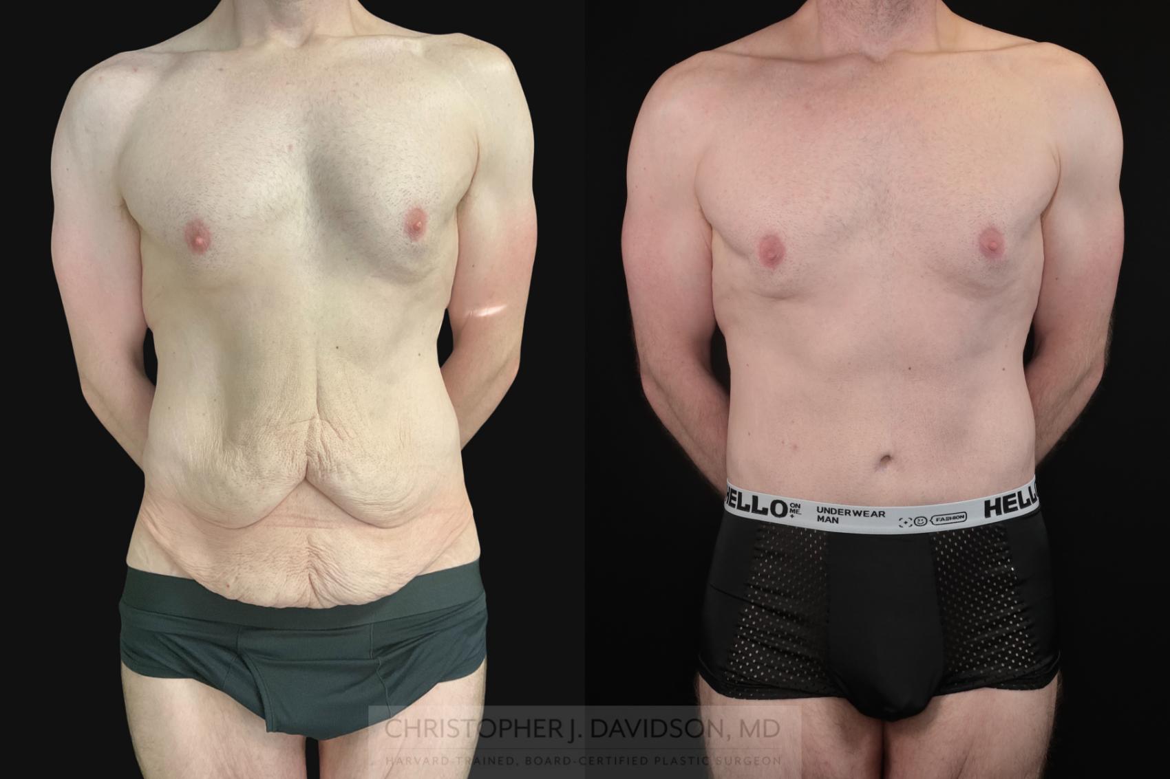 Lower Body Lift Case 486 Before & After Front | Boston, MA | Christopher J. Davidson, MD