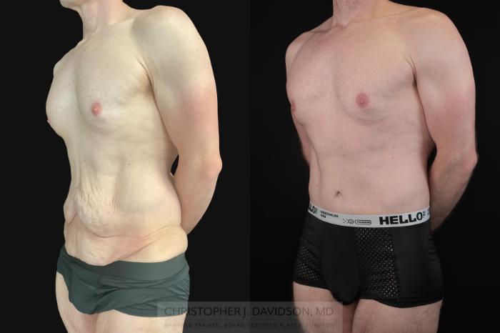 Lower Body Lift Case 486 Before & After Left Oblique | Boston, MA | Christopher J. Davidson, MD