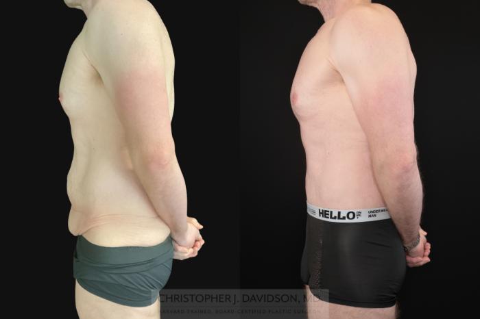 Lower Body Lift Case 486 Before & After Left Side | Boston, MA | Christopher J. Davidson, MD