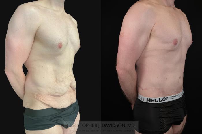 Lower Body Lift Case 486 Before & After Right Oblique | Boston, MA | Christopher J. Davidson, MD