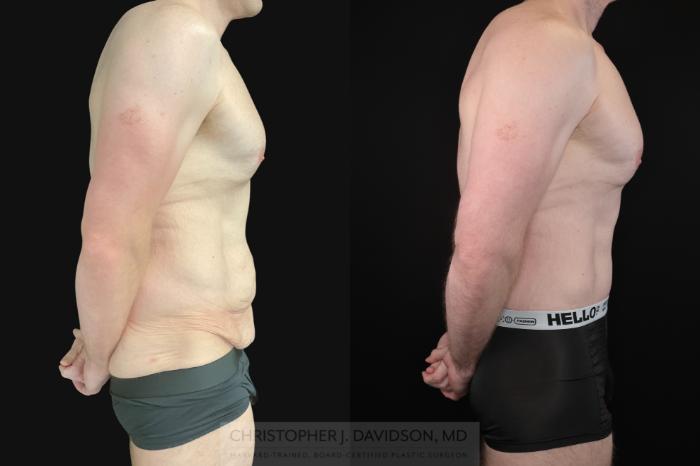 Lower Body Lift Case 486 Before & After Right Side | Boston, MA | Christopher J. Davidson, MD